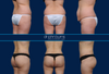 BBL and Tummy Tuck Before and After by Dr. John Burns, FACS