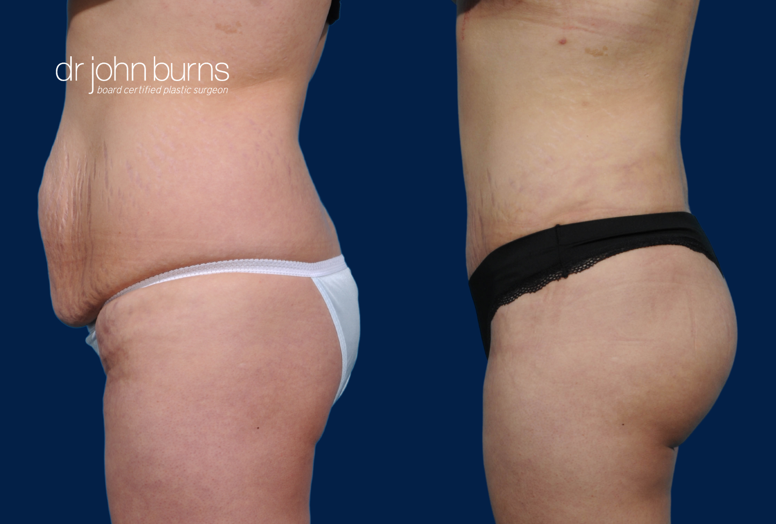 BBL and Tummy Tuck Before and After by Dr. John Burns, FACS