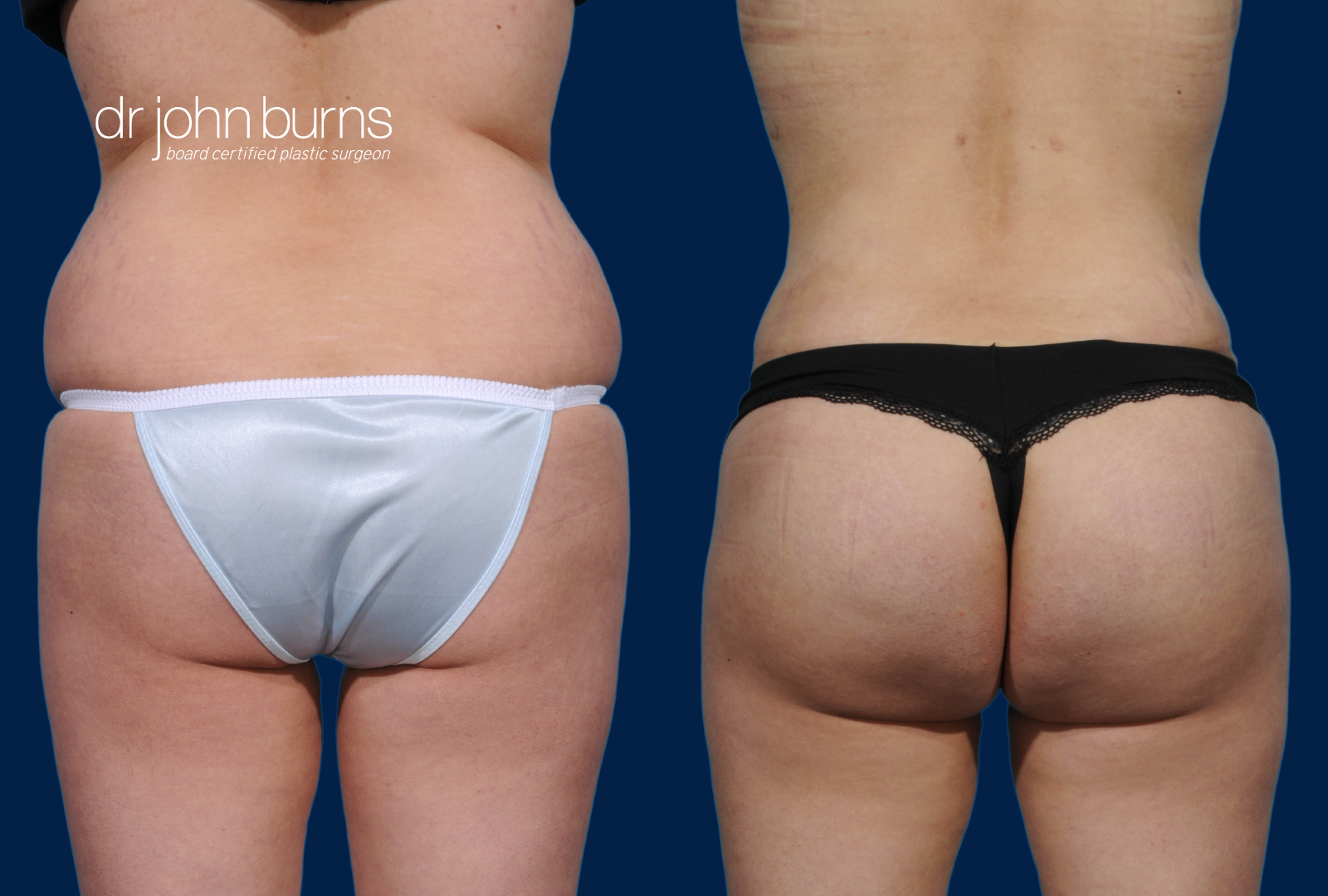 BBL and Tummy Tuck Before and After by Dr. John Burns, FACS