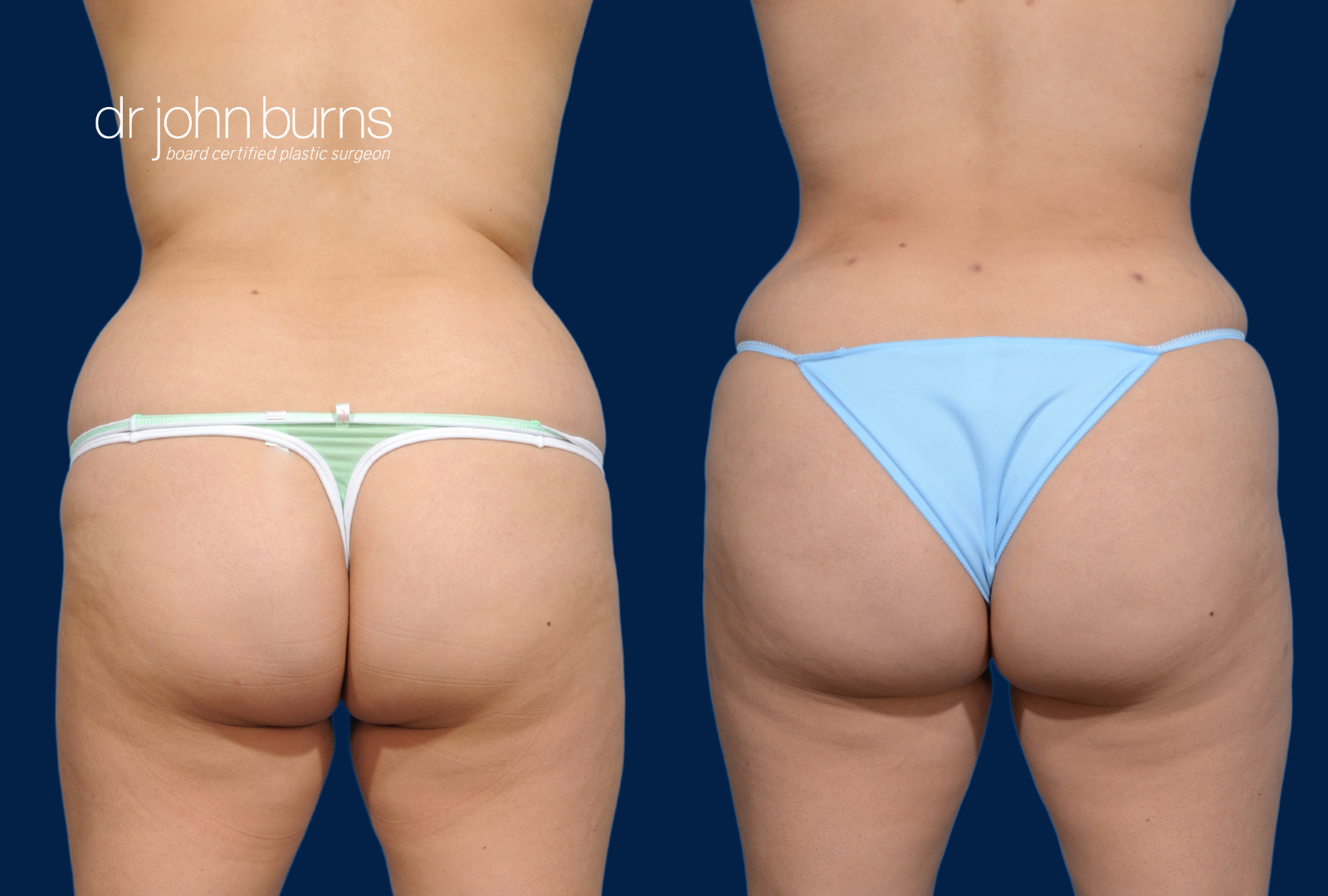 BBL- Brazilian Butt Lift Before & After with Tummy Tuck