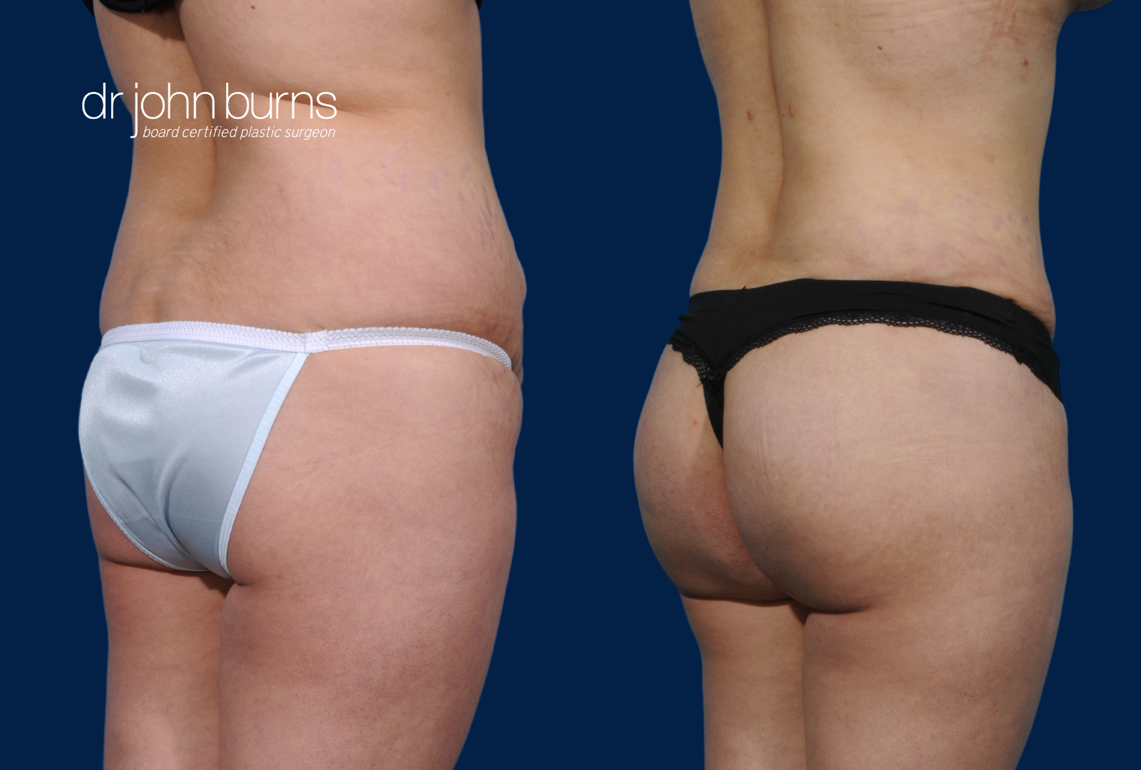 BBL and Tummy Tuck Before and After by Dr. John Burns, FACS