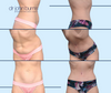 Tummy Tuck Before & After as part of a Mommy Makeover by Dallas Plastic Surgeon Dr. John Burns