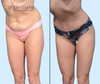 Loose Skin Removal | Tummy Tuck Before & After as part of a Mommy Makeover by Dallas Plastic Surgeon Dr. John Burns