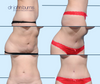Mini Tummy Tuck Results by Dallas Mommy Makeover Expert, Dr. John Burns