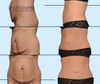 Before & After Dallas Mommy Makeover: Tummy Tuck + Lipo 360, by Dallas Plastic Surgeon Dr. John Burns