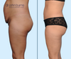 Profile View | Before & After Dallas Mommy Makeover: Tummy Tuck + Lipo 360, by Dallas Plastic Surgeon Dr. John Burns