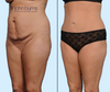 45 Degree View | Before & After Dallas Mommy Makeover: Tummy Tuck + Lipo 360, by Dallas Plastic Surgeon Dr. John Burns