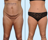 Anterior View | Before & After Dallas Mommy Makeover: Tummy Tuck + Lipo 360, by Dallas Plastic Surgeon Dr. John Burns