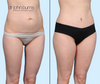 Mommy Makeover Results | Tummy Tuck + Lipo by Dallas Plastic Surgeon, Dr. John Burns | Right 45 Degree View
