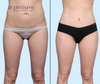Mommy Makeover Results | Tummy Tuck + Lipo by Dallas Plastic Surgeon, Dr. John Burns | Anterior View