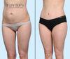 Mommy Makeover Results | Tummy Tuck + Lipo by Dallas Plastic Surgeon, Dr. John Burns | Left 45 Degree View