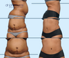 Before & After Mommy Makeover Tummy Tuck  with Lipo by Dallas Plastic Surgeon, Dr. John Burns