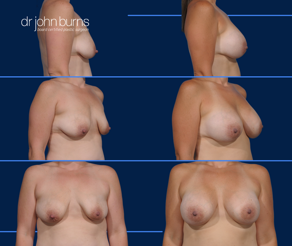 Before and After Breast Augmentation by Dr. John Burns