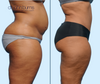 Profile View | Before & After Mommy Makeover Tummy Tuck  with Lipo by Dallas Plastic Surgeon, Dr. John Burns