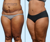 45 Degree View | Before & After Mommy Makeover Tummy Tuck  with Lipo by Dallas Plastic Surgeon, Dr. John Burns