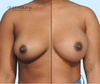 Before and After Breast Augmentation by Dr. John Burns
