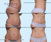 Before & After Tummy Tuck Results, Dallas Mommy Makeover Plastic Surgeon, Dr. John Burns