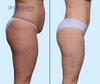 Profile View | Before & After Tummy Tuck Results, Dallas Mommy Makeover Plastic Surgeon, Dr. John Burns