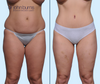 Anterior View | Before & After Tummy Tuck Results, Dallas Mommy Makeover Plastic Surgeon, Dr. John Burns