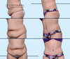 Before & After Extended Tummy Tuck in A Mommy Makeover by Dallas Plastic Surgeon, Dr. John Burns