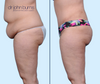 Profile View | Before & After Extended Tummy Tuck in A Mommy Makeover by Dallas Plastic Surgeon, Dr. John Burns