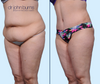 45 Degree View | Before & After Extended Tummy Tuck in A Mommy Makeover by Dallas Plastic Surgeon, Dr. John Burns