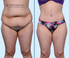 Anterior View | Before & After Extended Tummy Tuck in A Mommy Makeover by Dallas Plastic Surgeon, Dr. John Burns