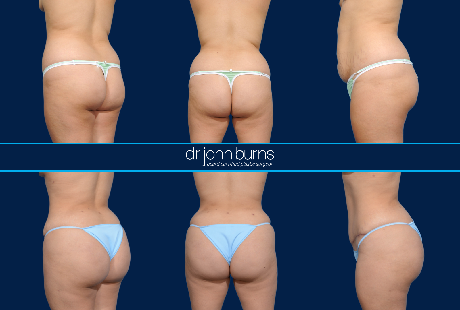 Dallas BBL-Brazilian Butt Lift- Before and After Pics by Dr. John Burns,  FACS – Dr John Burns