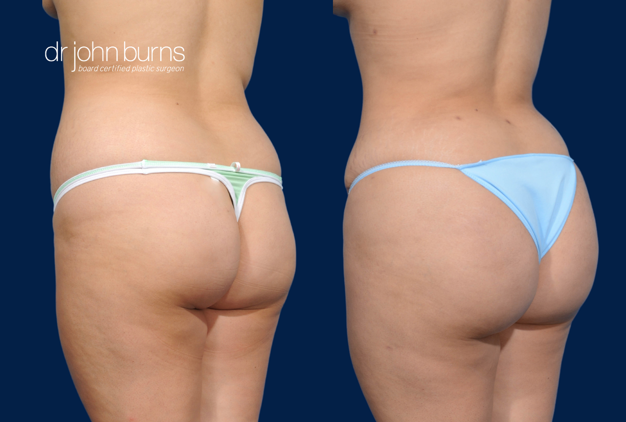 BBL- Brazilian Butt Lift Before & After with Tummy Tuck