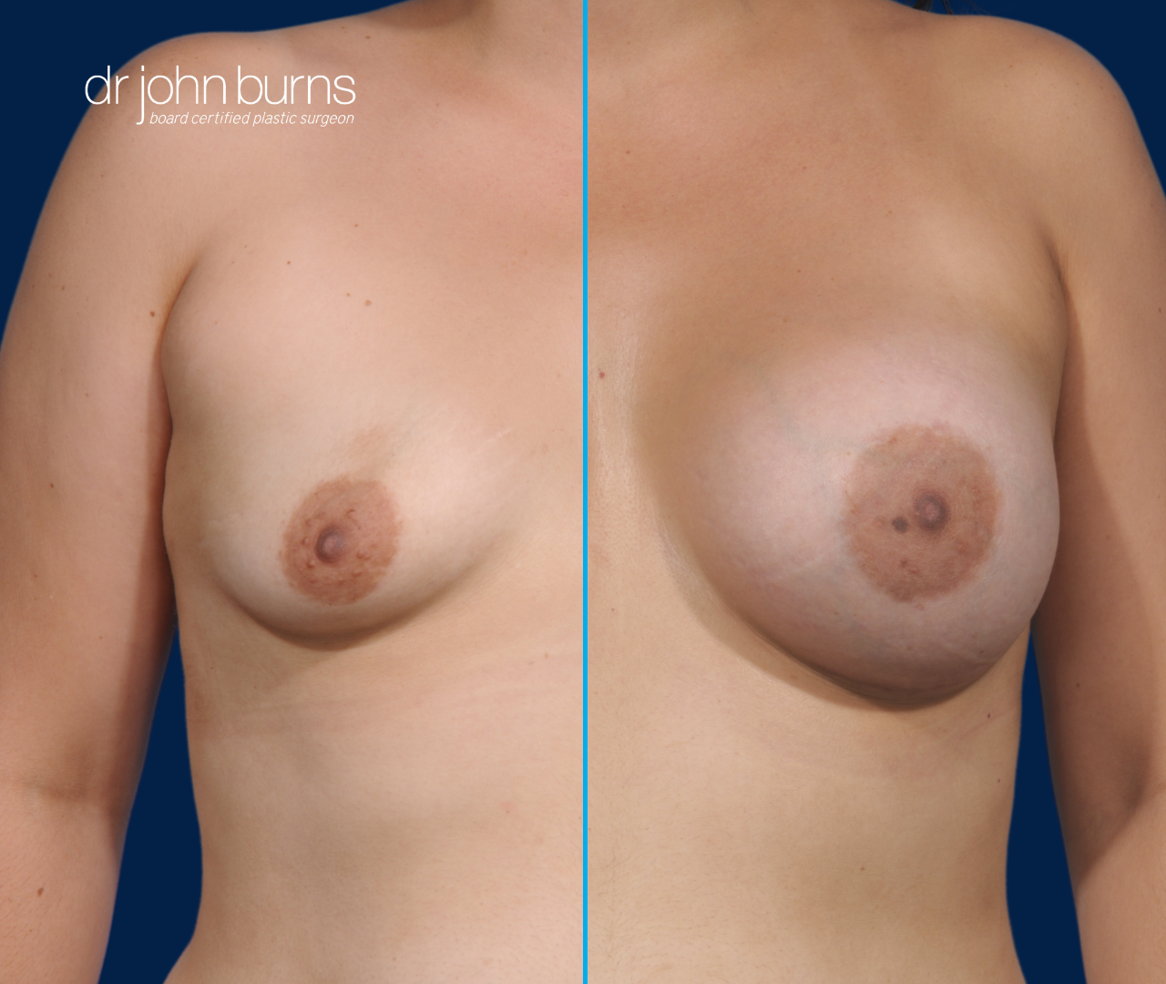 Before & After Breast Implants by Dr. John Burns, Dallas Plastic Surgeon