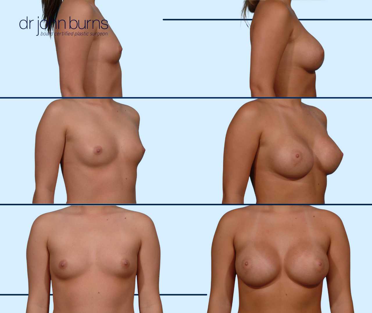 Breast Augmentation Results by Dr. John Burns in Dallas, Texas