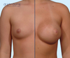 Breast Augmentation Results by Dr. John Burns in Dallas, Texas