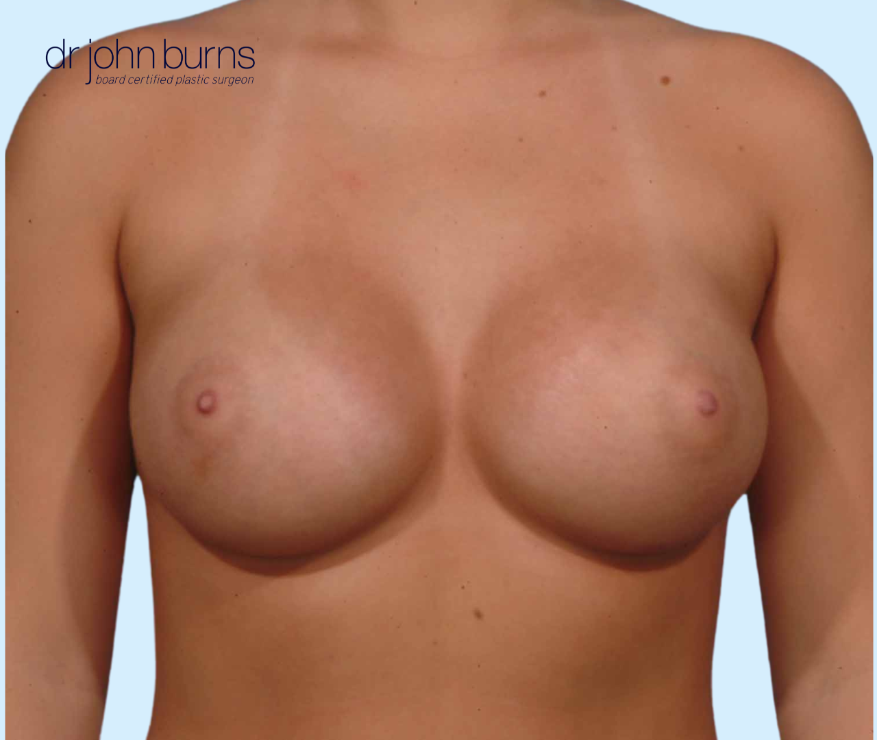 Breast Implant Results by Dallas plastic surgeon Dr. John Burns