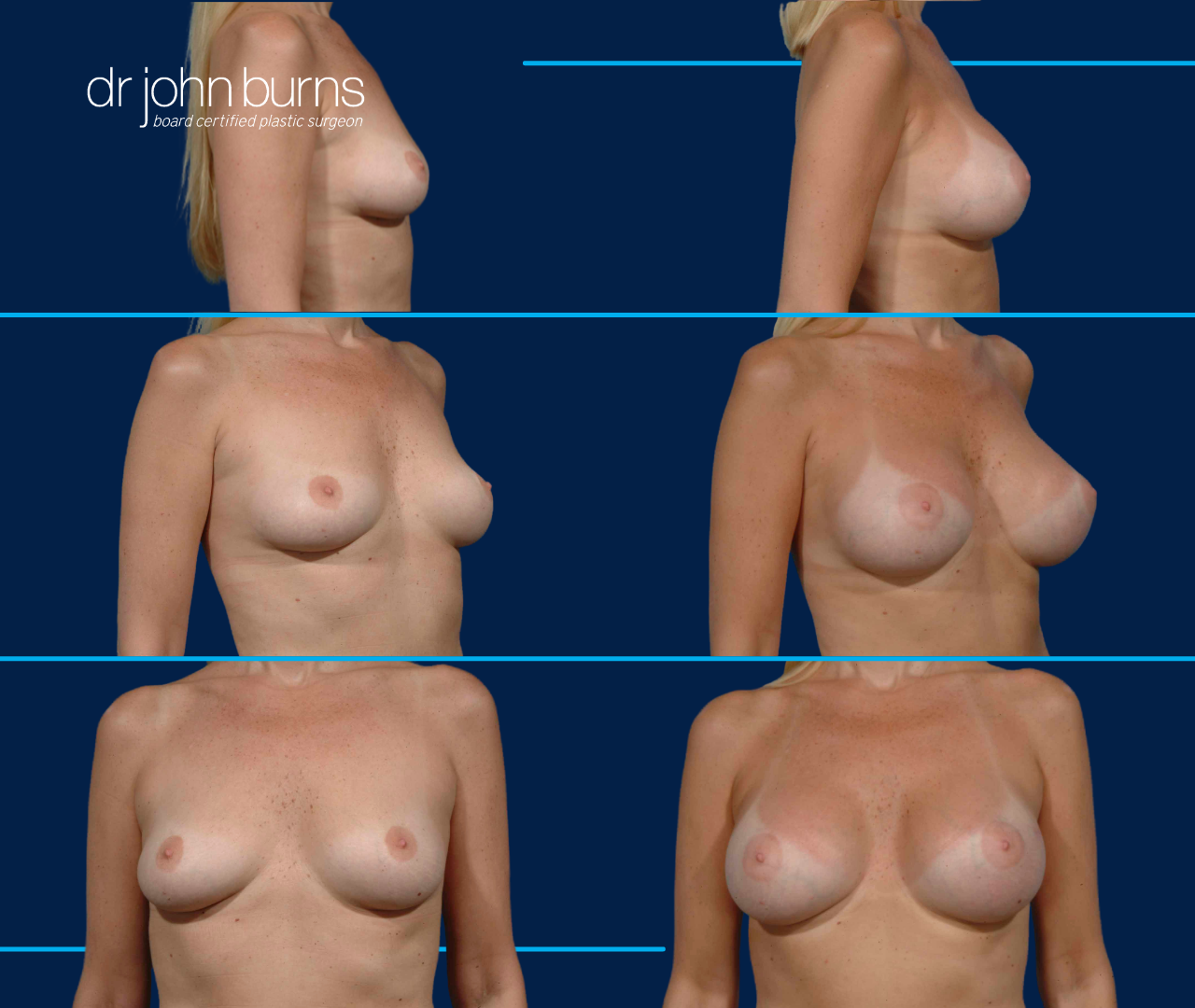 B to D Cup Breast Augmentation by Dr. John Burns in Dallas, Texas