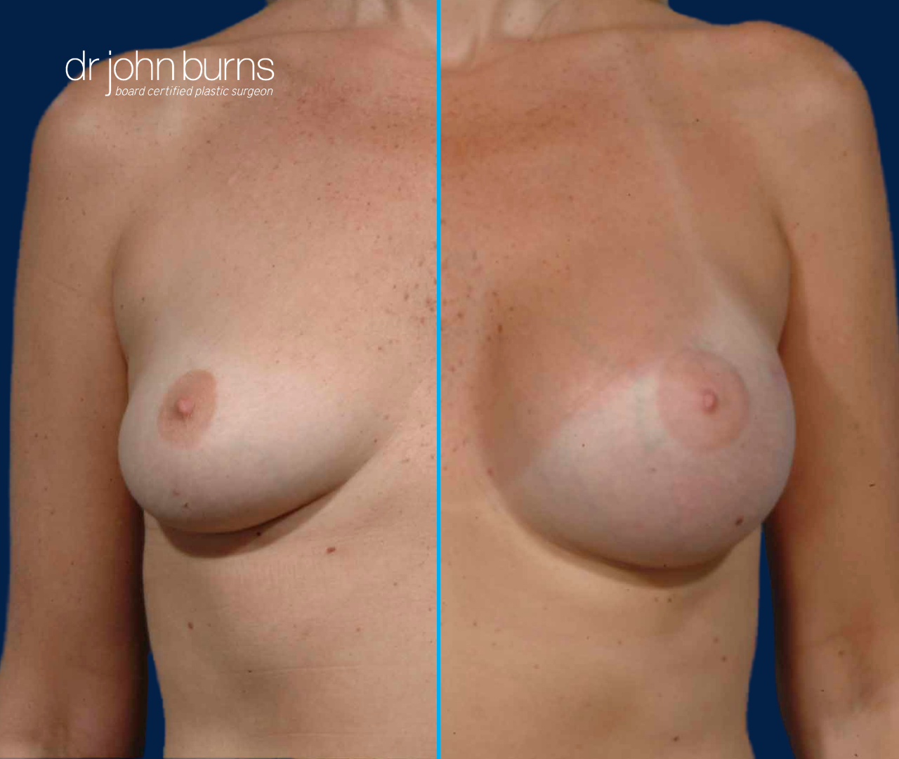 Before and After B to D cup breast augmentation by Dr. John Burns