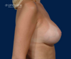 Right Profile View, After B to D Cup Breast Augmentation by Dr. John Burns in Dallas, Texas