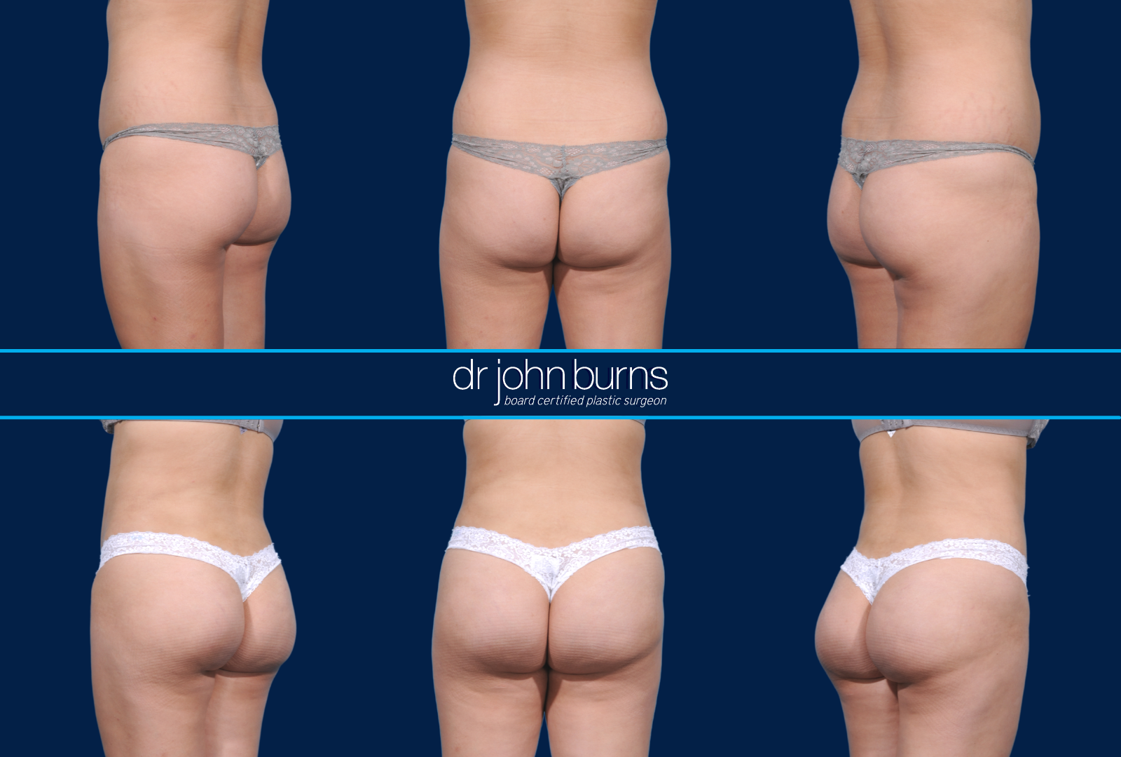 Brazilian Butt Lift Before & After by Dr. John Burns
