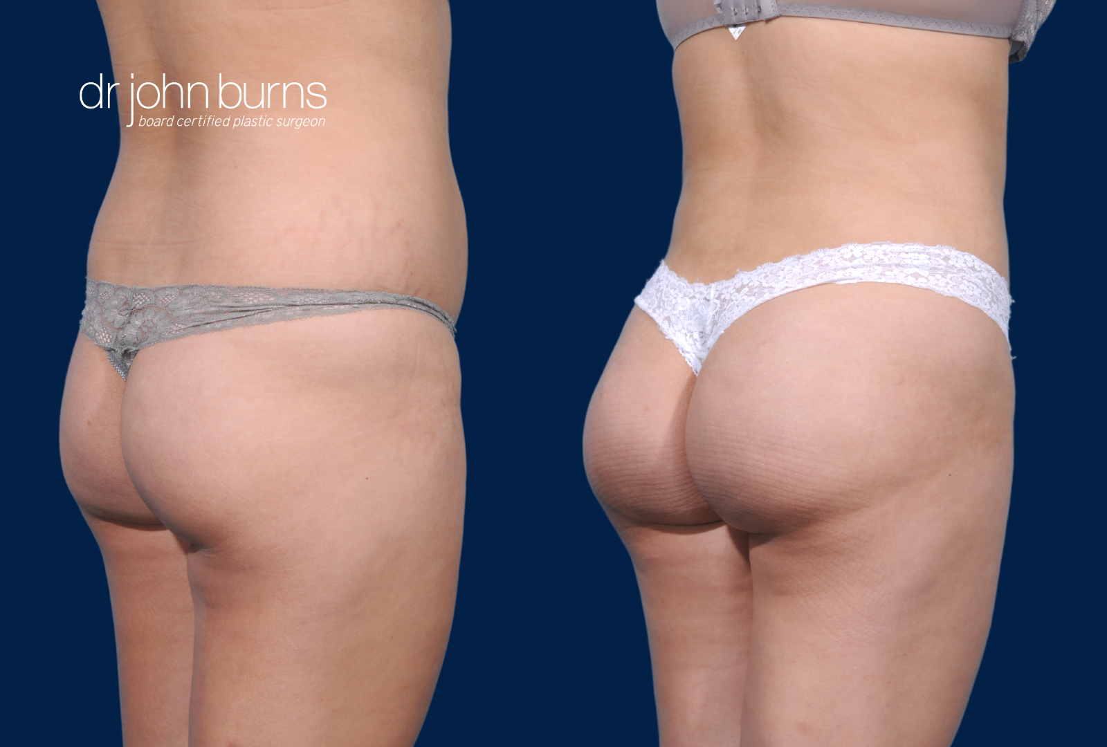 Brazilian Butt Lift Before & After by Dr. John Burns
