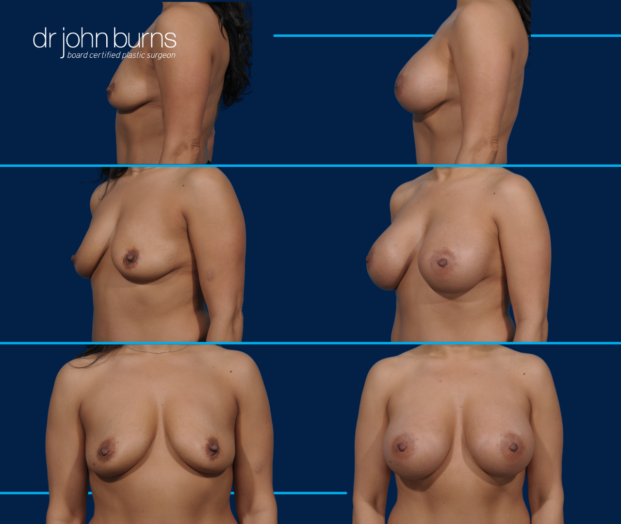 B to D Breast augmentation results by Dr. John Burns