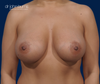 Dual Plane Silicone Gel Breast Augmentation Results by Dr. John Burns