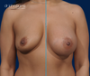 Before & After Breast Augmentation Results