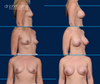 A to B Cup breast augmentation by Dr. John Burns