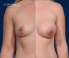 A to B Cup breast augmentation by Dr. John Burns