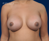 After Mommy Makeover breast augmentation to correct breast asymmetry by Dr. John Burns