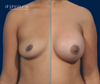 Before and After Mommy Makeover breast augmentation to correct breast asymmetry by Dr. John Burns