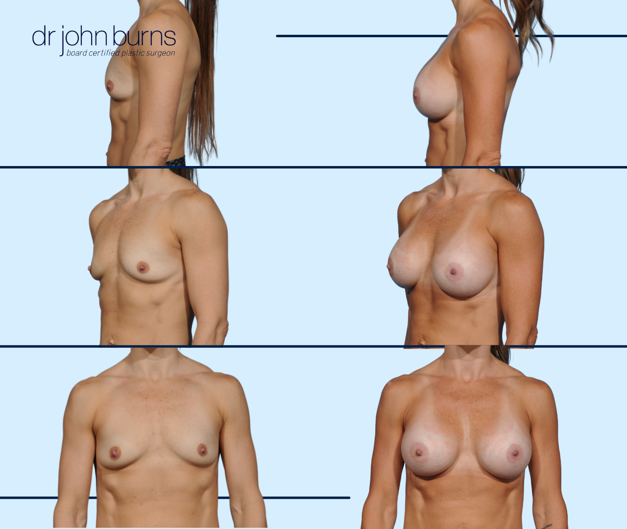 Before & After Subfascial Breast Augmentation by Dr. John Burns