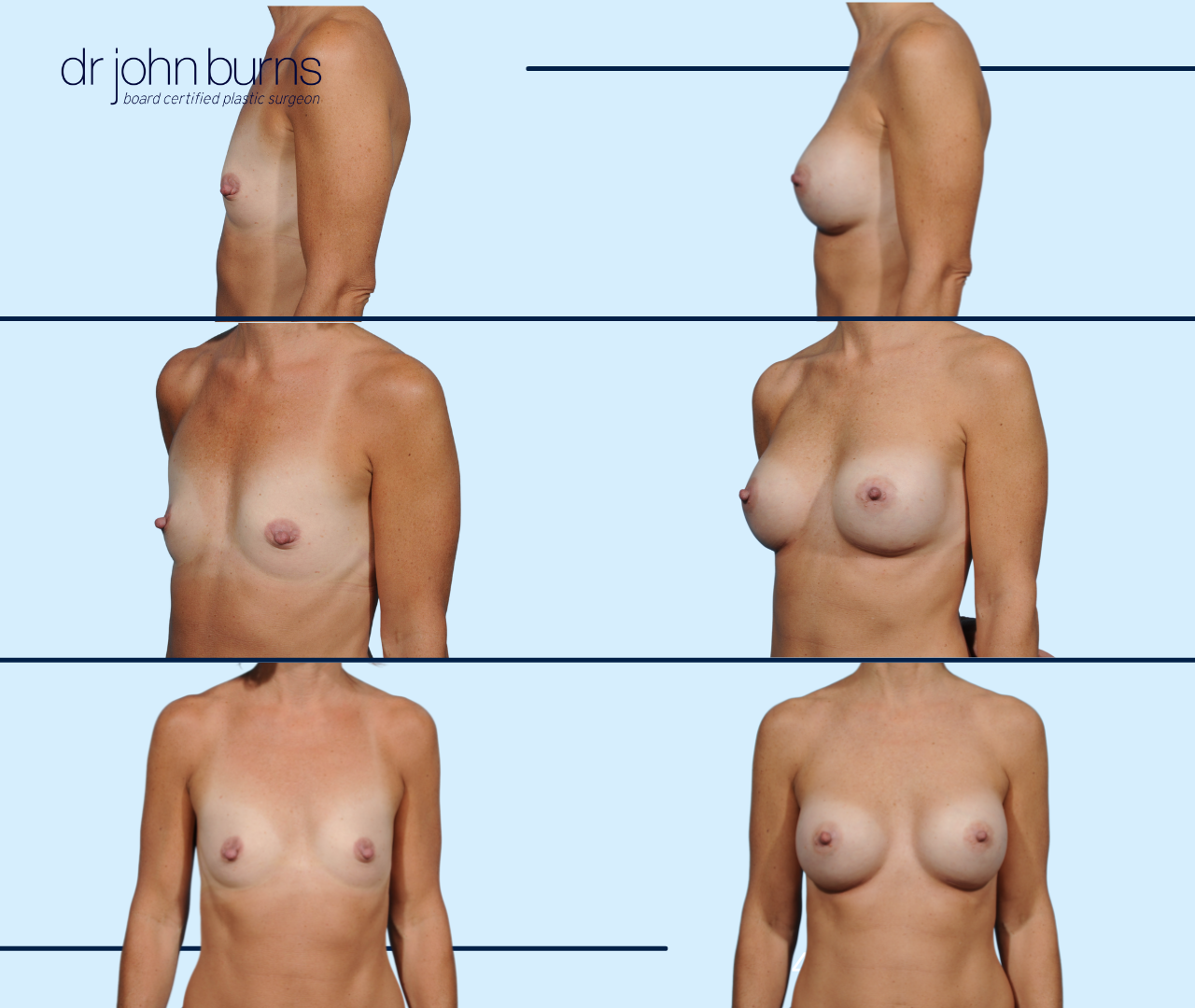 Before & After 330 cc Breast Implants by Dr. John Burns