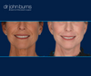 Mouth Area, Before & After Facelift, Neck lift, fat transfer and laser resurfacing by Dr. John Burns in Dallas, Texas