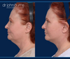 Before and After facelift surgery, SMASectomy and eyelid surgery by Facelift specialist Dr. John Burns in Dallas
