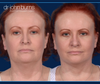 Before and After Facelift with SMASectomy and eyelid surgery-Dr. John Burns
